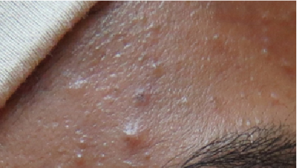 whitehead and papules